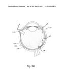 THERAPEUTIC AGENT DELIVERY DEVICE WITH CONVERGENT LUMEN diagram and image