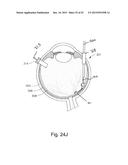 THERAPEUTIC AGENT DELIVERY DEVICE WITH CONVERGENT LUMEN diagram and image