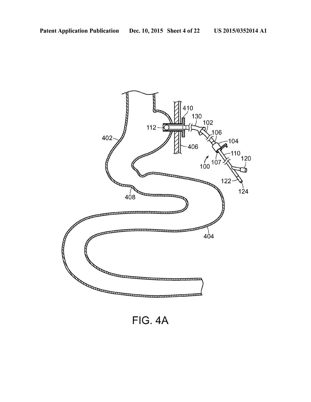 Jejunal Feeding Tube And Delivery System - diagram, schematic, and image 05