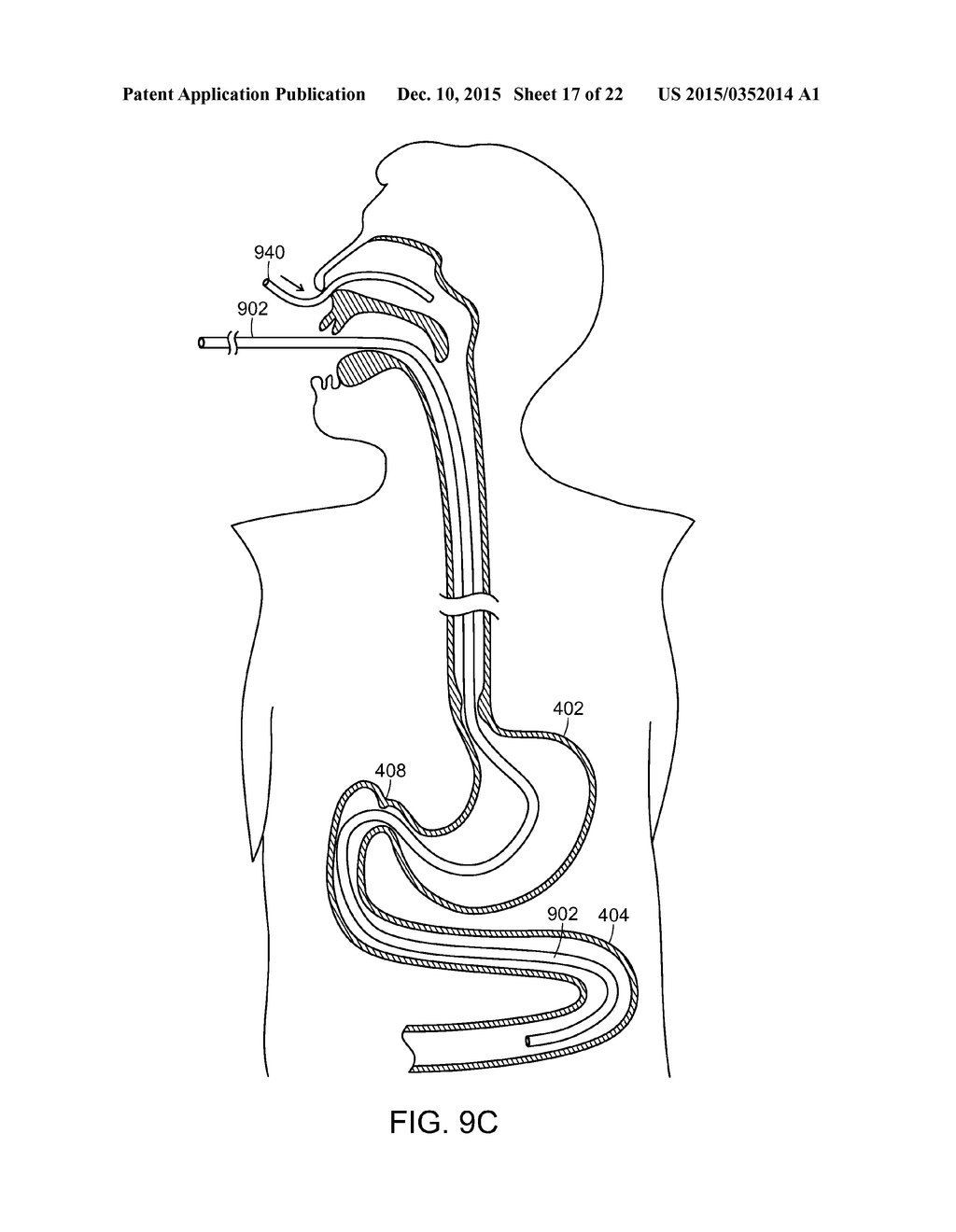 Jejunal Feeding Tube And Delivery System - diagram, schematic, and image 18