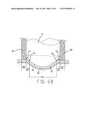 DISK DRIVE SUSPENSION ASSEMBLY HAVING A PARTIALLY FLANGELESS LOAD POINT     DIMPLE diagram and image