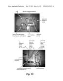 ASSESSING ENDOTHELIAL FUNCTION USING A BLOOD PRESSURE CUFF diagram and image