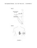 Portable Heart Motion Monitor diagram and image