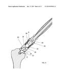 INSTRUMENT FOR THE REMOVAL OF A BONE INSERT AND CORRESPONDING METHOD diagram and image