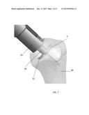 INSTRUMENT FOR THE REMOVAL OF A BONE INSERT AND CORRESPONDING METHOD diagram and image