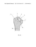 INSTRUMENT FOR THE REMOVAL OF A BONE INSERT AND CORRESPONDING METHOD diagram and image