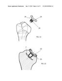 INSTRUMENT FOR THE REMOVAL OF A BONE INSERT AND CORRESPONDING METHOD diagram and image