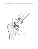 INSTRUMENT FOR THE REMOVAL OF A BONE INSERT AND CORRESPONDING METHOD diagram and image