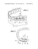 ORTHODONTIC INDIRECT BONDING TRAY INCLUDING STABILIZATION FEATURES diagram and image