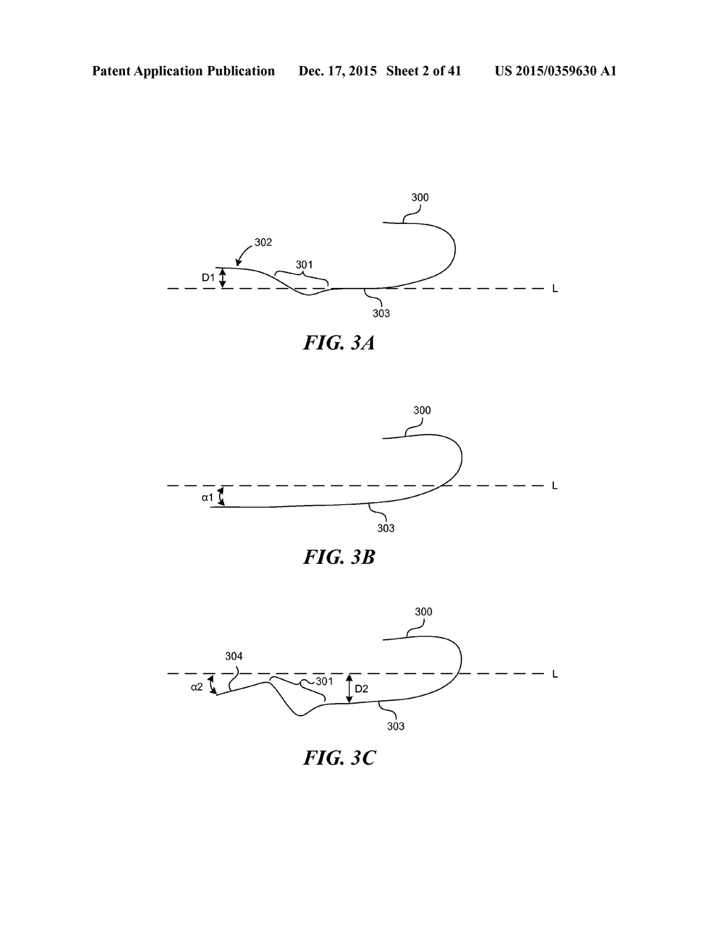 SYSTEMS AND METHODS FOR ENDOLUMINAL VALVE CREATION - diagram, schematic, and image 03