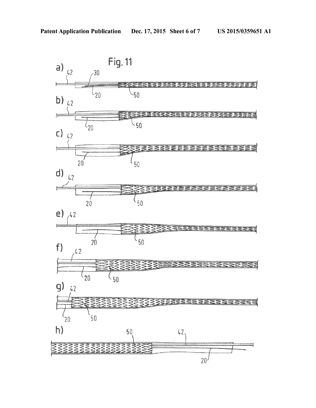 Catheter Sheath for Implant Delivery - diagram, schematic, and image 07