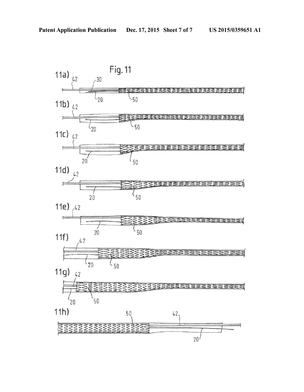 Catheter Sheath for Implant Delivery - diagram, schematic, and image 08