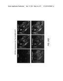 TRANSCRIPTION FACTOR-BASED GENERATION OF PACEMAKER CELLS AND METHODS OF     USING SAME diagram and image