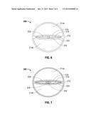 CATHETER HAVING AN EXPANDABLE LUMEN AND METHOD OF MANUFACTURE diagram and image