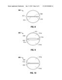 CATHETER HAVING AN EXPANDABLE LUMEN AND METHOD OF MANUFACTURE diagram and image