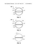 CATHETER HAVING AN EXPANDABLE LUMEN AND METHOD OF MANUFACTURE diagram and image