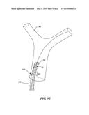 RETRACTION AND ASPIRATION DEVICE FOR TREATING EMBOLISM AND ASSOCIATED     SYSTEMS AND METHODS diagram and image