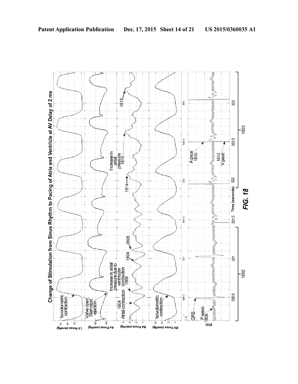 Methods And Systems For Controlling Blood Pressure By Controlling Atrial     Pressure - diagram, schematic, and image 15