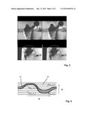 METAL RESISTANT MR IMAGING diagram and image