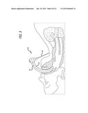 ENDOTRACHEAL INTUBATION DEVICES diagram and image