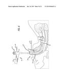 ENDOTRACHEAL INTUBATION DEVICES diagram and image