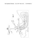 ENDOTRACHEAL INTUBATION DEVICES diagram and image