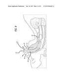 ENDOTRACHEAL INTUBATION DEVICES diagram and image