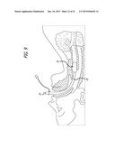 ENDOTRACHEAL INTUBATION DEVICES diagram and image