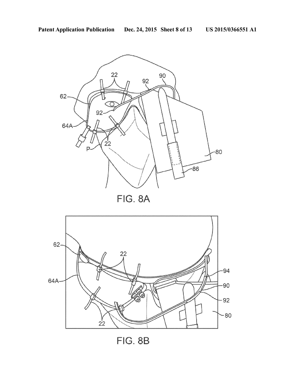 PATIENT-SUPPORTED OPHTHALMIC PLATFORMS - diagram, schematic, and image 09