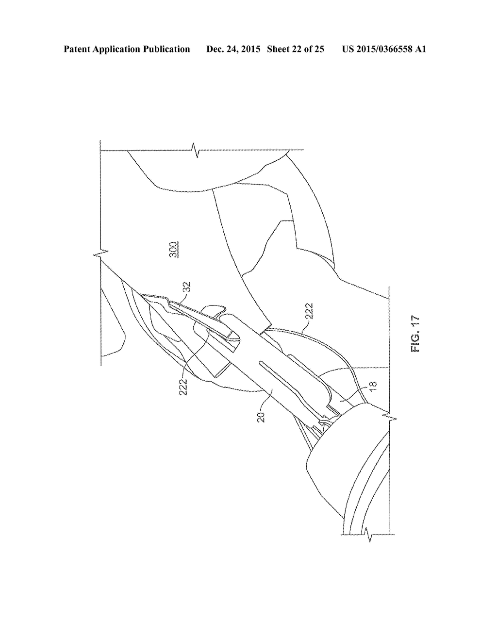 SUTURE PASSING - diagram, schematic, and image 23