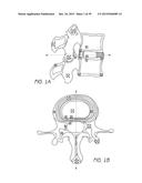 BONE ANCHOR SYSTEMS diagram and image