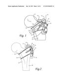 Periprosthetic Plating System Including Plate with System for Retaining     Tension on a Cable diagram and image