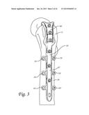 Periprosthetic Plating System Including Plate with System for Retaining     Tension on a Cable diagram and image