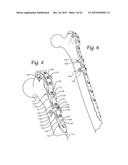 Periprosthetic Plating System Including Plate with System for Retaining     Tension on a Cable diagram and image