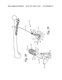 Periprosthetic Plating System Including Plate with System for Retaining     Tension on a Cable diagram and image