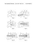 MEDICAL DEVICE, APPARATUS, AND SURGICAL METHOD diagram and image