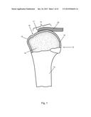 Arthroscopic Method and Apparatus for Rotator Cuff Repair diagram and image