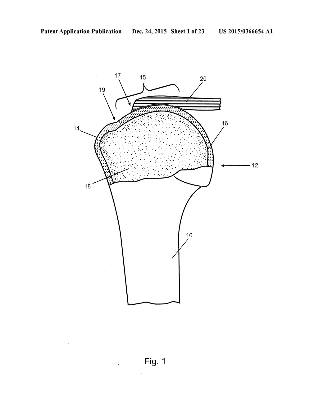 Arthroscopic Method and Apparatus for Rotator Cuff Repair - diagram, schematic, and image 02