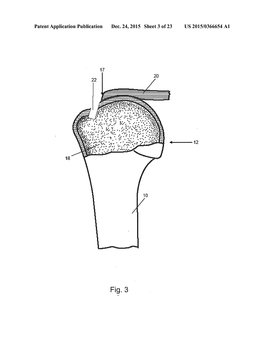 Arthroscopic Method and Apparatus for Rotator Cuff Repair - diagram, schematic, and image 04