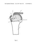 Arthroscopic Method and Apparatus for Rotator Cuff Repair diagram and image