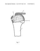 Arthroscopic Method and Apparatus for Rotator Cuff Repair diagram and image