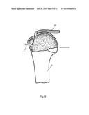 Arthroscopic Method and Apparatus for Rotator Cuff Repair diagram and image