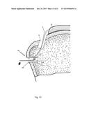 Arthroscopic Method and Apparatus for Rotator Cuff Repair diagram and image