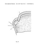 Arthroscopic Method and Apparatus for Rotator Cuff Repair diagram and image