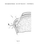 Arthroscopic Method and Apparatus for Rotator Cuff Repair diagram and image