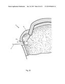 Arthroscopic Method and Apparatus for Rotator Cuff Repair diagram and image