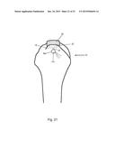 Arthroscopic Method and Apparatus for Rotator Cuff Repair diagram and image