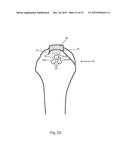 Arthroscopic Method and Apparatus for Rotator Cuff Repair diagram and image