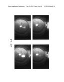 PROSTHETIC CAPSULAR DEVICES, SYSTEMS, AND METHODS diagram and image