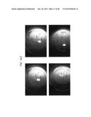 PROSTHETIC CAPSULAR DEVICES, SYSTEMS, AND METHODS diagram and image